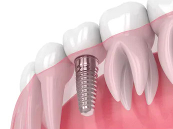 Close up Implant model tooth support fix bridge implant and crown.