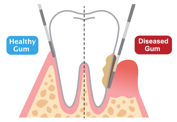 periodontal probing depth showing healthy and diseased gum. dental and health care concept - Royalty-free Human Gums stock vector